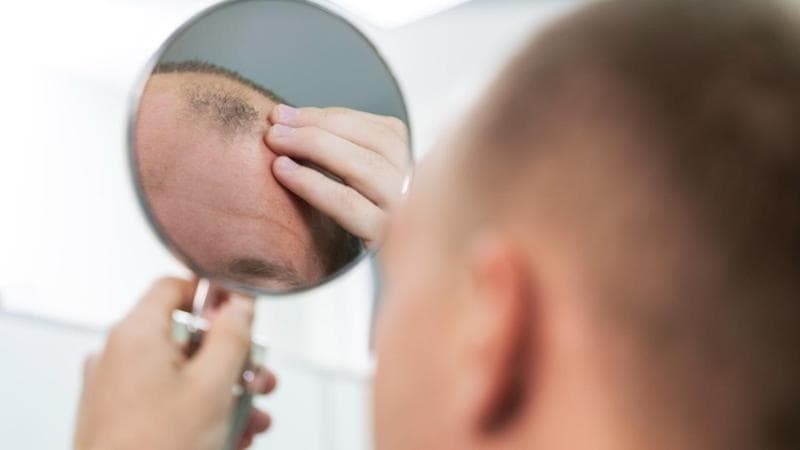 Trapianti di capelli, dalla Puglia partono in centinaia per l’intervento all’estero: le loro storie - Bari