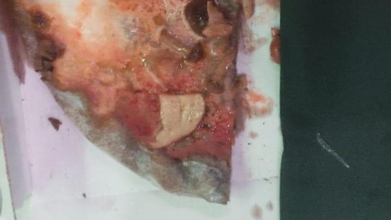 Lecce, nella pizza c’e un vetro: lesione alla gola per un uomo. “Dopo 4 mesi ancora in terapia” - Bari