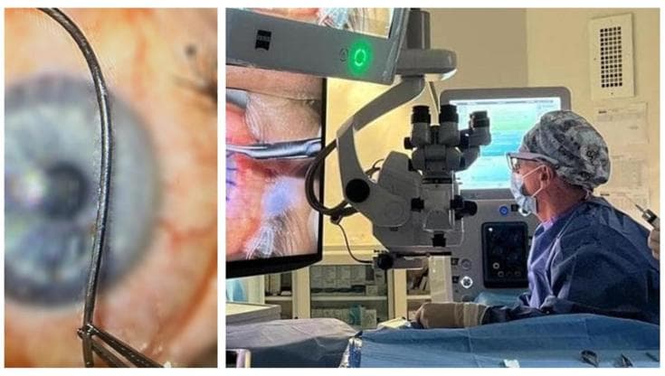 Immagine del post 20467 - Bari Putignano, scheggia in metallo da 2,5 centimetri estratta da un occhio: salvata la vista a operaio - Bari