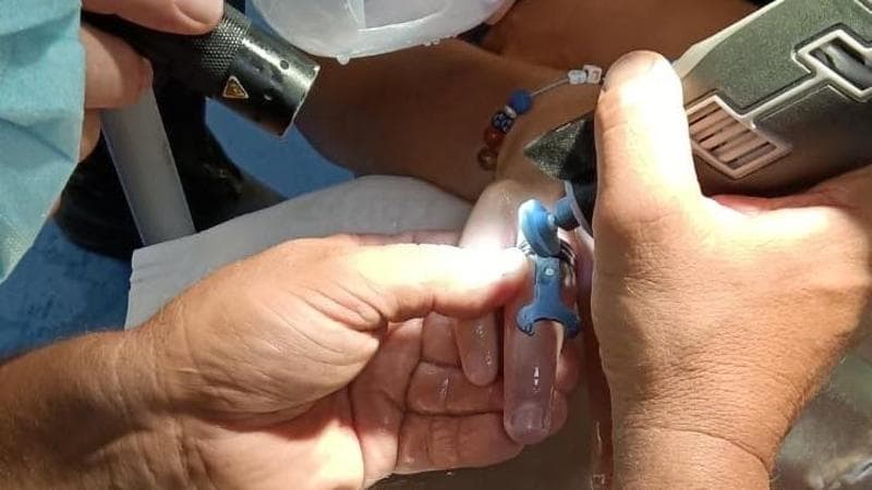 Immagine del post 10876 - Bari Anelli incastrati dopo puntura di insetto, arriva in ospedale con mano gonfia. Salvato dai pompieri - Bari