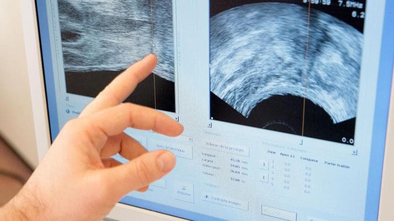 Salute, da Foggia progetto per la prevenzione del tumore alla prostata. “Diagnosi precoce semplice” - Bari