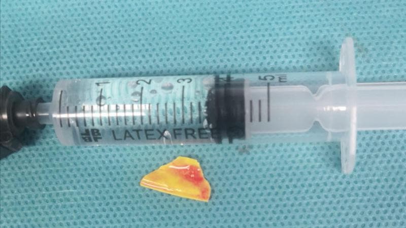 Immagine del post 6338 - Bari Scheggia di plastica incastrata nella gola, bimba di 14 mesi salvata al Pediatrico di Bari - Bari
