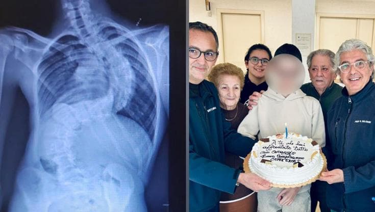 Immagine del post 15274 - Bari Operato per una gravissima scoliosi a 13 anni, passerà Natale a casa: “Può tornare a vita normale” - Bari