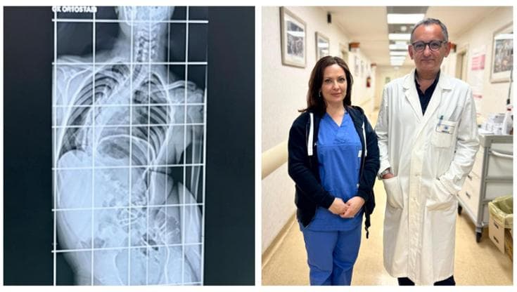 Immagine del post 21058 - Bari Da Napoli al Policlinico di Bari per un delicato intervento di scoliosi. “Il ragazzo presto a casa” - Bari